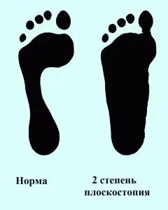 Чи беруть в армію з плоскостопістю ступеня хвороби і заклик (ступеня) Чи беруть в армію з плоскостопістю ступеня хвороби і заклик