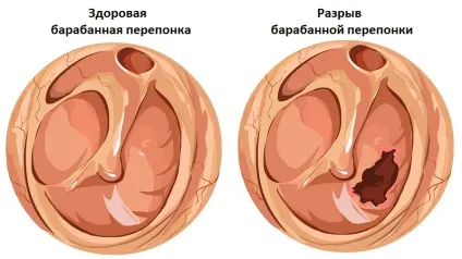 Баротравма вуха - набряк, симптоми і лікування баротравми