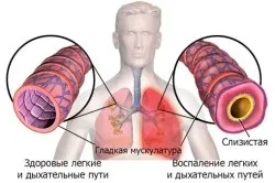 Тривалий бронхіт симптоми і лікування (лікування) Тривалий бронхіт симптоми і лікування