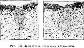 Загоєння ран - хірургія
