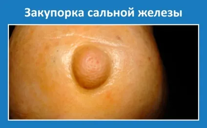 Закупорка сальних залоз опис з фото (залози) Закупорка сальних залоз опис з фото