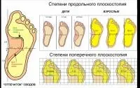 Біль у ступні під пальцями - причини, лікування і профілактика (біль) Біль у ступні під пальцями - причини, лікування і профілактика