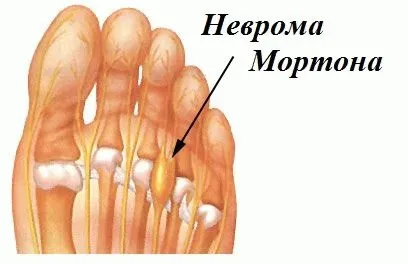 Біль у стопі під пальцями при ходьбі, в чому причина (ходьбі) Біль у стопі під пальцями при ходьбі, в чому причина