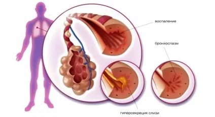 Бронхіт і астма чим відрізняється і як виявити (астматичний бронхіт алергічний) Бронхіт і астма чим відрізняється і як виявити