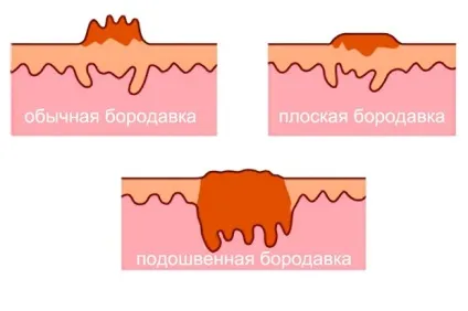 Бородавка на пальці руки як позбутися, вивести і видалити, вірусна (вивести) Бородавка на пальці руки як позбутися, вивести і видалити, вірусна