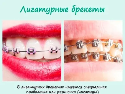 Брекети лігатурні різновиди переваги і недоліки (недоліки) Брекети лігатурні різновиди переваги і недоліки
