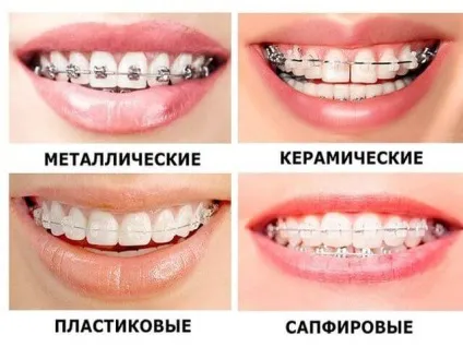 Брекети лігатурні різновиди переваги і недоліки (різновиди) Брекети лігатурні різновиди переваги і недоліки