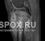 Чим небезпечна Хвороба Осгуд-Шляттера для юних спортсменів (хвороба) Чим небезпечна Хвороба Осгуд-Шляттера для юних спортсменів