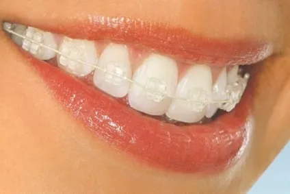 Чим небезпечний неправильний прикус, види неправильного прикусу і протезування при неправильному (види неправильного прикусу) Чим небезпечний неправильний прикус, види неправильного прикусу і протезування при неправильному