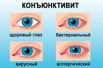 Що робити якщо нежить і сльозяться очі - як правильно лікувати (нежить) Що робити якщо нежить і сльозяться очі - як правильно лікувати