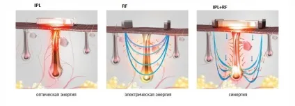 Що краще, елос епіляція або лазерна відмінності і подібності