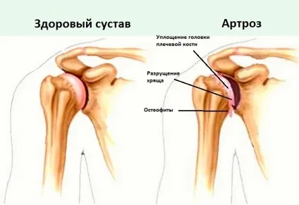 Що робити якщо хрумтить плечовий суглоб і болить (робити) Що робити якщо хрумтить плечовий суглоб і болить