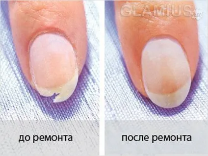 Що робити, якщо зламався ніготь - які вжити заходів при поломці нігтя (ніготь) Що робити, якщо зламався ніготь - які вжити заходів при поломці нігтя