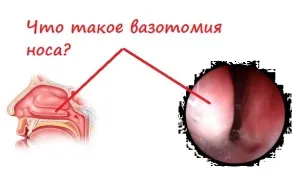 Що таке вазотомія носа (таке) Що таке вазотомія носа
