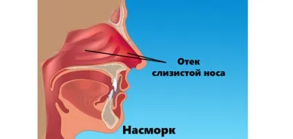 Що таке вазомоторний риніт і причини судинного нежиті у дорослих (риніт) Що таке вазомоторний риніт і причини судинного нежиті у дорослих