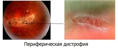 Дегенерація сітківки ока (сітківки) Дегенерація сітківки ока