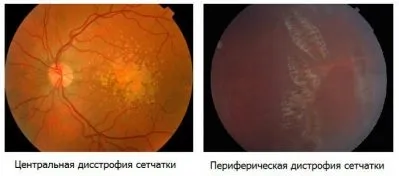 Дегенерація сітківки ока (дегенерація) Дегенерація сітківки ока