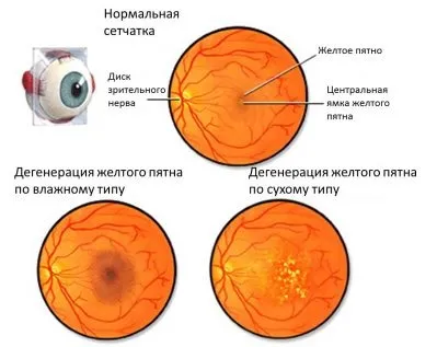 Дегенерація сітківки ока (дегенерація) Дегенерація сітківки ока
