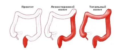 Дієта при різних видах діареї у дорослого (дієта) Дієта при різних видах діареї у дорослого