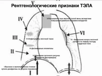 ЕКГ при ТЕЛА, ознаки тромбоемболії легеневої артерії (серця судинної системи) ЕКГ при ТЕЛА, ознаки тромбоемболії легеневої артерії