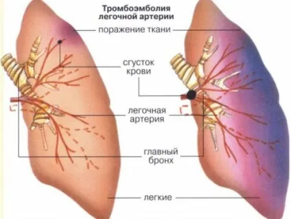 ЕКГ при ТЕЛА, ознаки тромбоемболії легеневої артерії (тромбоемболії) ЕКГ при ТЕЛА, ознаки тромбоемболії легеневої артерії