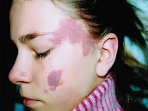 Фіолетові (сині) плями на шкірі що це таке, як лікувати (фіолетові) Фіолетові (сині) плями на шкірі що це таке, як лікувати