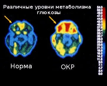 Фобія боязнь мікробів