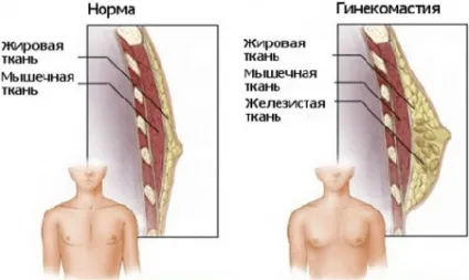 Гінекомастія у чоловіків що це таке, симптоми і лікування без операції, видалення (чоловіків) Гінекомастія у чоловіків що це таке, симптоми і лікування без операції, видалення