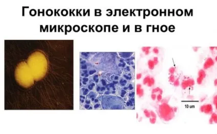 Гонококовий уретрит (гонорейний) у чоловіків і жінок (жінок) Гонококовий уретрит (гонорейний) у чоловіків і жінок