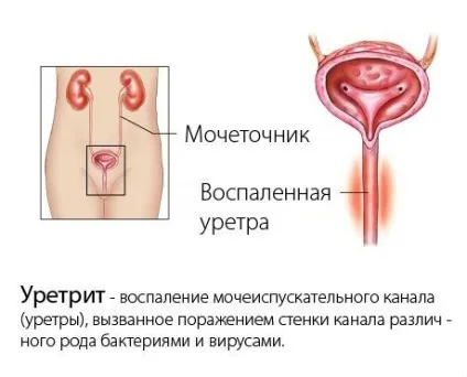 Гонококовий уретрит (гонорейний) у чоловіків і жінок (чоловіків) Гонококовий уретрит (гонорейний) у чоловіків і жінок