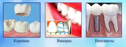 Виправлення прикусу коронками - кардинальне рішення (виправлення) Виправлення прикусу коронками - кардинальне рішення