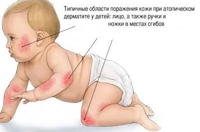 Як давати активоване вугілля новонародженим і немовлятам (активоване вугілля новонародженим) Як давати активоване вугілля новонародженим і немовлятам