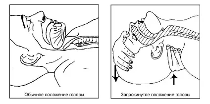 Як робити штучне дихання рот в рот правильно і ін способи (робити штучне дихання) Як робити штучне дихання рот в рот правильно і ін способи