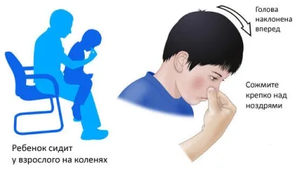 Як швидко зупинити кров з носа при високому тиску в домашніх умовах (зупинити) Як швидко зупинити кров з носа при високому тиску в домашніх умовах