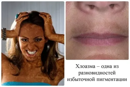 Як боротися з придбаної гиперпигментацией комбінуємо методики (гиперпигментацией) Як боротися з придбаної гиперпигментацией комбінуємо методики