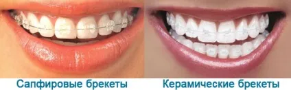 Які брекети краще керамічні або сапфірові про виправлення прикусу і брекети (естетичні брекети) Які брекети краще керамічні або сапфірові про виправлення прикусу і брекети