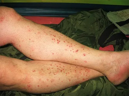 Як позбутися від піщаних бліх (бліх) Як позбутися від піщаних бліх