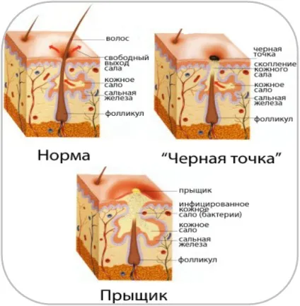 Як позбутися від прищів в перехідному віці (віком) Як позбутися від прищів в перехідному віці