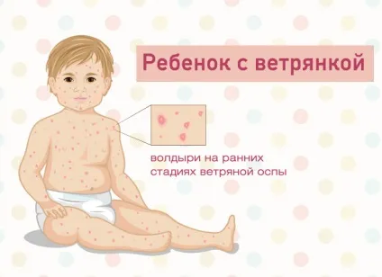 Як лікувати вітрянку і чим вона небезпечна топ-5 основних правил (діти) Як лікувати вітрянку і чим вона небезпечна топ-5 основних правил
