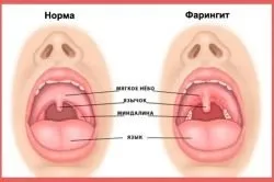 Як визначити який кашель сухий або вологий (визначити) Як визначити який кашель сухий або вологий