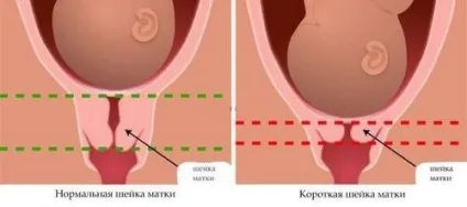 Як визначити довжину шийки матки при вагітності, як визначити вагітність (матки) Як визначити довжину шийки матки при вагітності, як визначити вагітність