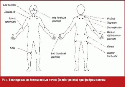 Які симптоми фіброзіти (фибромиалгии) і як його лікувати (симптоми) Які симптоми фіброзіти (фибромиалгии) і як його лікувати