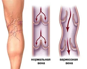 Як запобігти варикозу на ногах уникнути варикозне розширення вен, лікування варикозу (варикоз) Як запобігти варикозу на ногах уникнути варикозне розширення вен, лікування варикозу