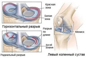Печіння в колінному суглобі - які можуть бути причини - живи здорово (печіння) Печіння в колінному суглобі - які можуть бути причини - живи здорово
