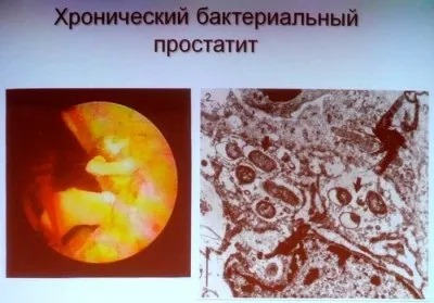 Печіння і свербіж в сечівнику у чоловіків без виділень після семяіспусканія