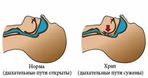 Як вилікувати хропіння - відгуки пацієнтів центру медицини сну - Барвиха
