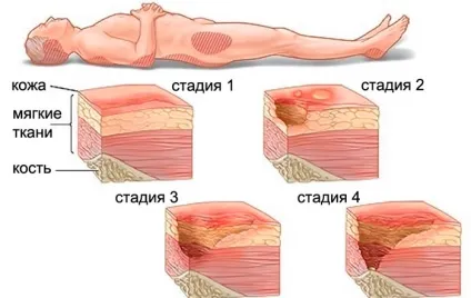 Як вибрати протипролежневі матрац, на що звернути увагу (звернути) Як вибрати протипролежневі матрац, на що звернути увагу