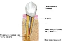 Як витягнути гній з ясен (ясна) Як витягнути гній з ясен