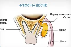 Як витягнути гній з ясен (витягнути гній ясна) Як витягнути гній з ясен