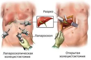 Камінь в жовчному міхурі чи робити операцію, як жити (міхурі) Камінь в жовчному міхурі чи робити операцію, як жити